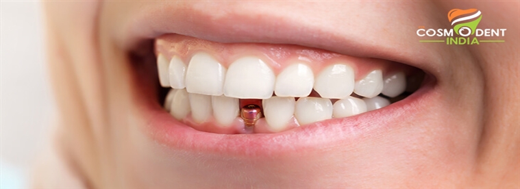 benefits-of-dental-implants