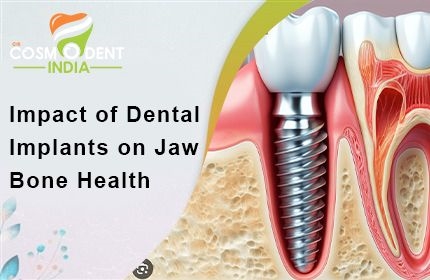 impact-of-dental-implants-on-jaw-bone-health