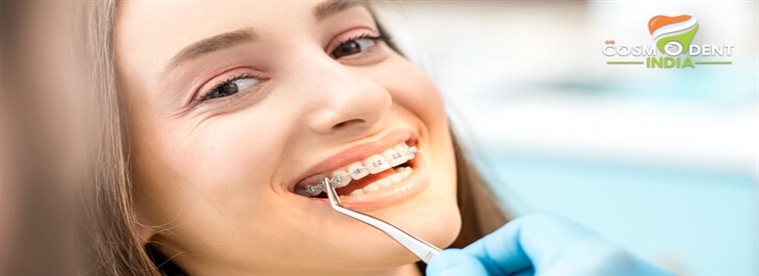 teeth-braces-and-their-utility