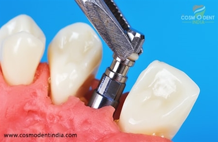 benefits-of-immediate-dental-implants