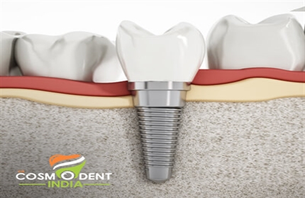 best-dental-implants-in-india