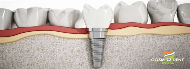 best-dental-implants-in-india