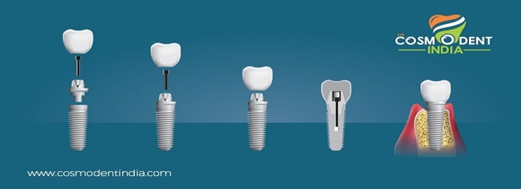 implante dental-preparación-etapas-resultados