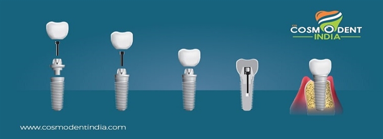 dental-implant-preparation-stages-results