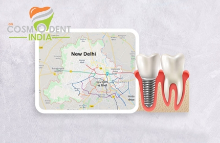 best-dental-implant-treatment-centre-in-delhi