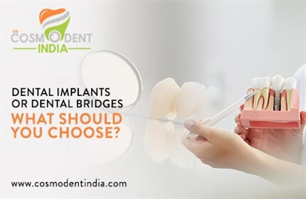 dental-implants-or-dental-bridges-what-should-you-choose