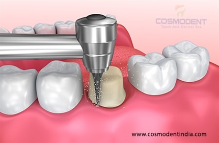 get-the-best-dental-implants-in-india-by-the-best-doctor