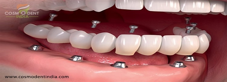 how-much-does-it-cost-for-full-dental-implants