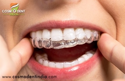 invisalign-braces-treatment-in-india