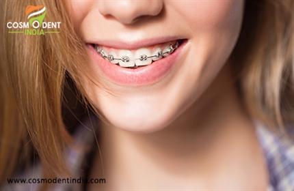 invisalign-teeth-braces