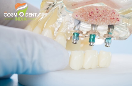 know-about-dental-implants