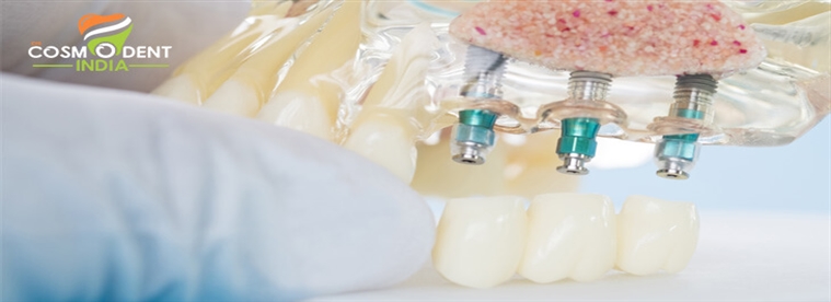 know-about-dental-implants