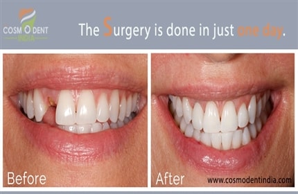 more-about-our-teeth-in-a-day-procedure