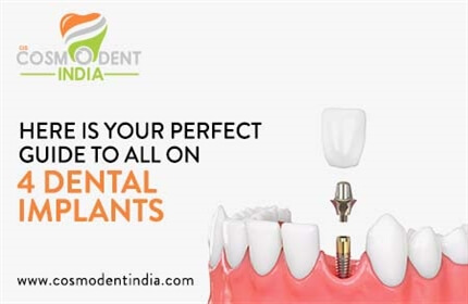 perfect-guide-to-all-on-4-dental-implants