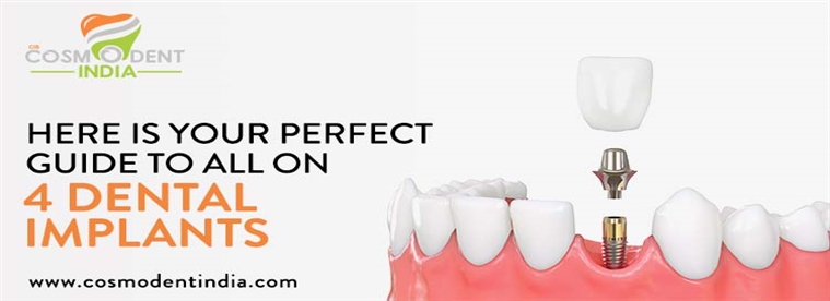 guía-perfecta-para-todos-en-4-implantes-dentales