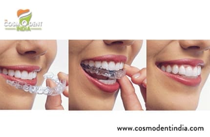 the-invisalign-treatment-process