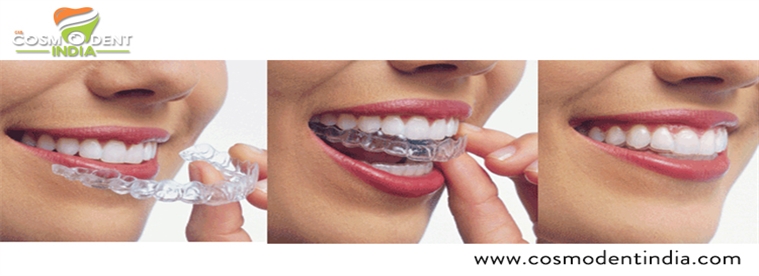 the-invisalign-treatment-process