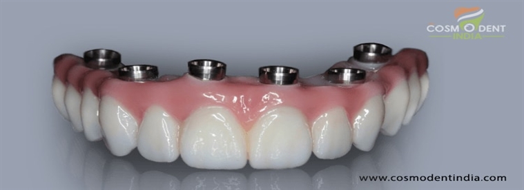 what-is-a-dental-implant-bridge