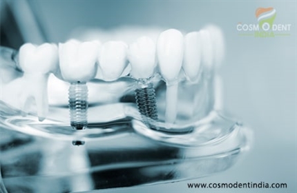 what-to-consider-before-going-for-all-on-4-dental-implants