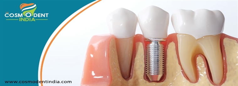 zygoma-implantes-reemplazo de dientes a pesar de mala calidad ósea