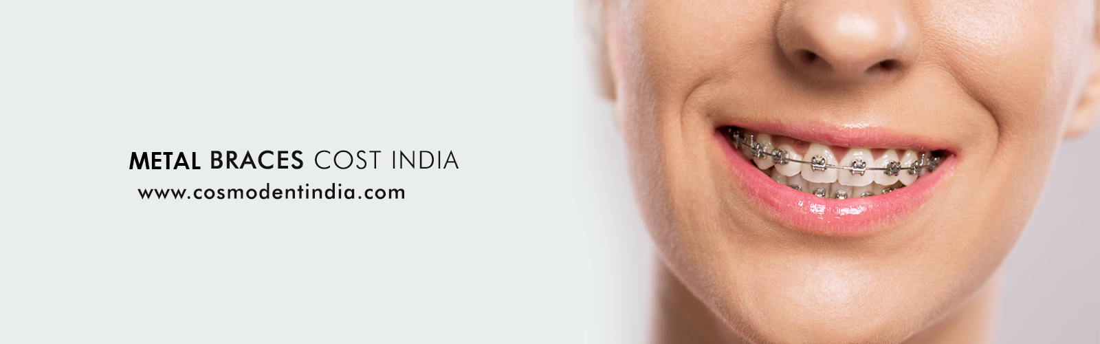 Metal Braces Treatment in Gurgaon Delhi India at Affordable Cost