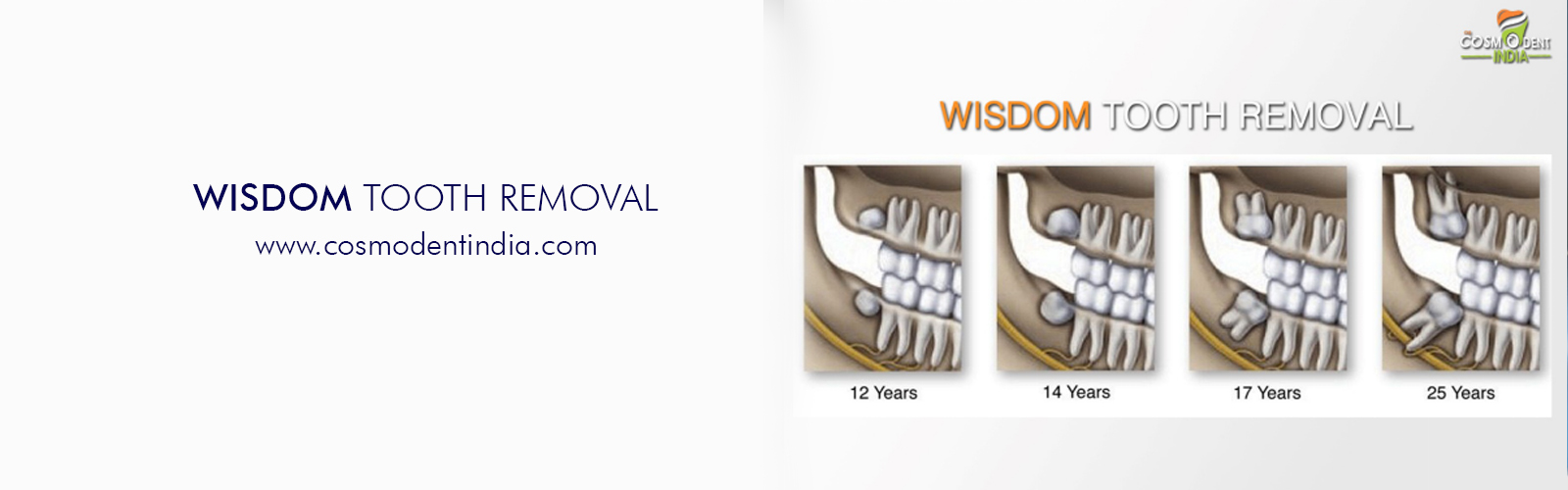 wisdom-tooth-removal