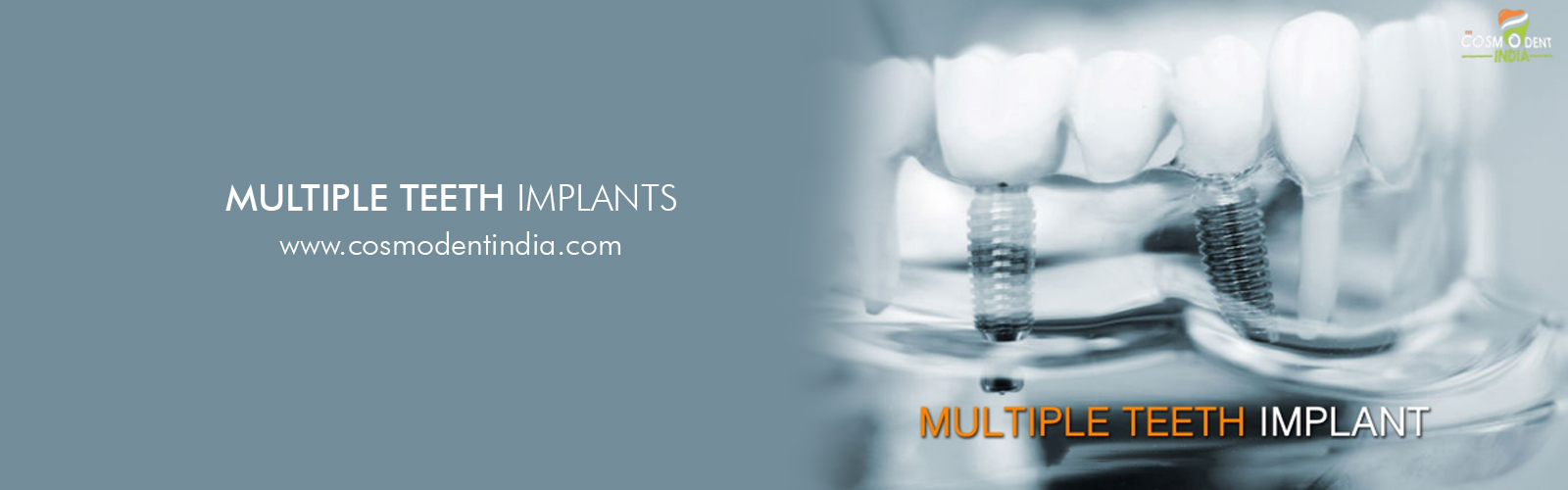 multiple-teeth-dental-implant-india
