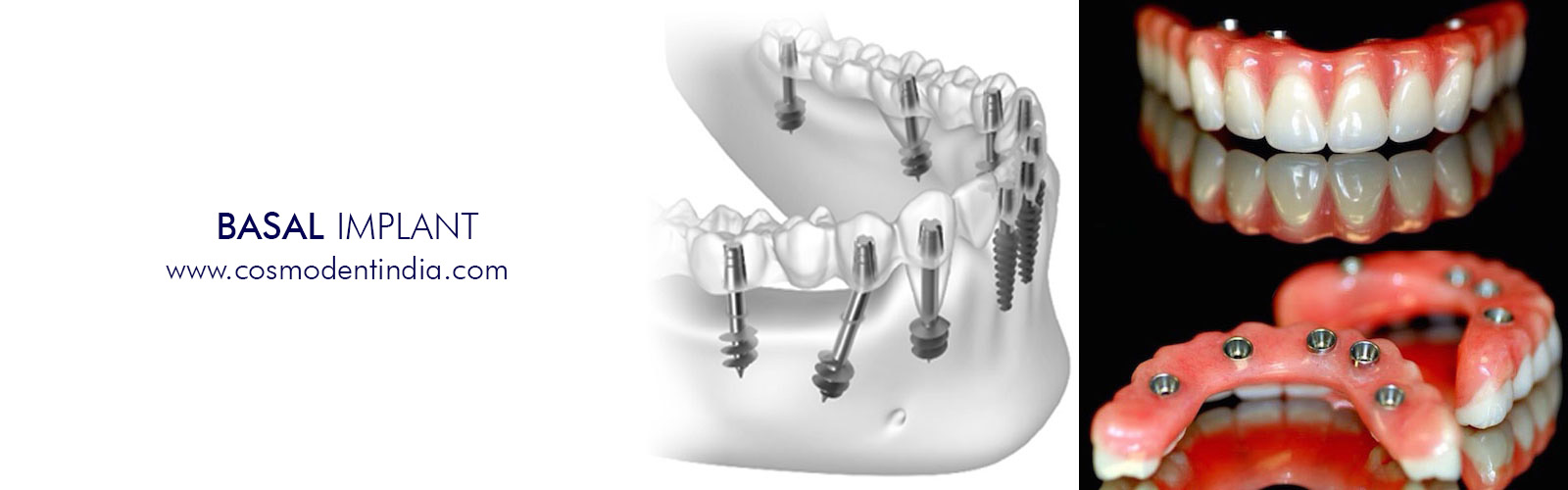 basal-implants-cost-in-india