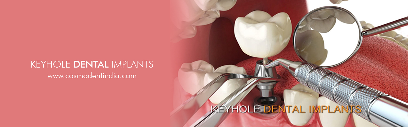 llave-agujero-implantes dentales