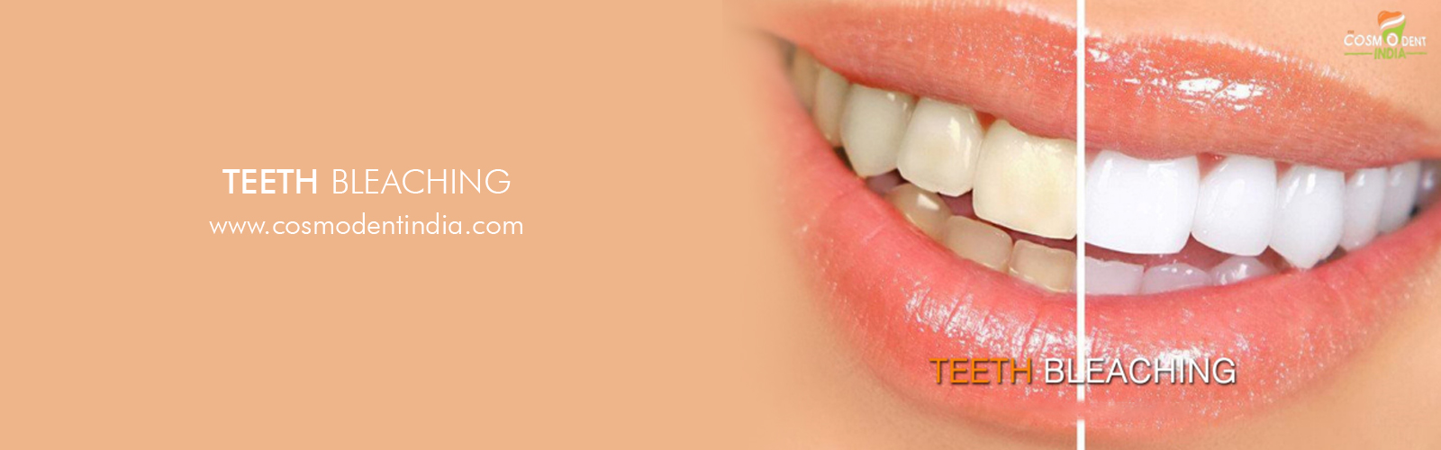 tooth-whitening-in-india