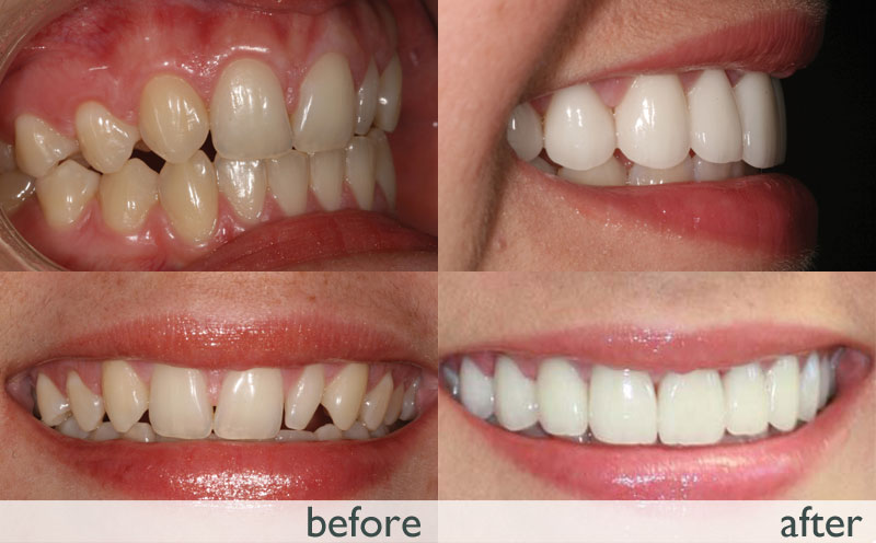 How much does it cost to put braces in india Invisalign Teeth Braces Cost In India Teeth Brace Cost Cosmodent India