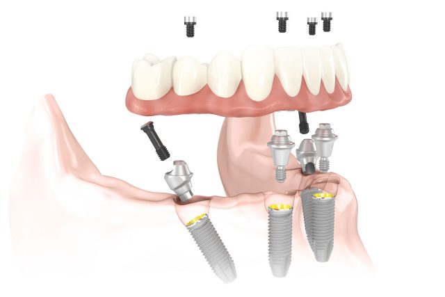 all-on-4-dental-implants