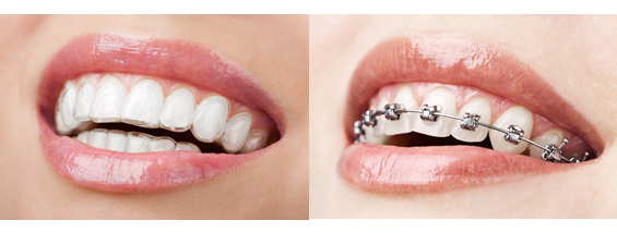 braces invisalign cost india invisible orthodontics manchester teeth adult options aligners treatment regular different archives