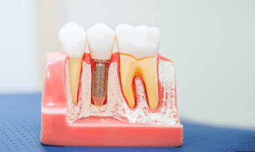 root-canal-treatment-cost-in-india