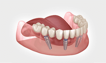 dental-crown-in-india